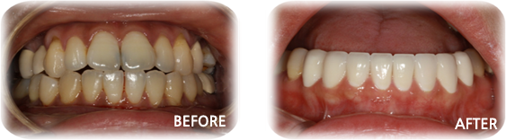 치아성형 사례6-2